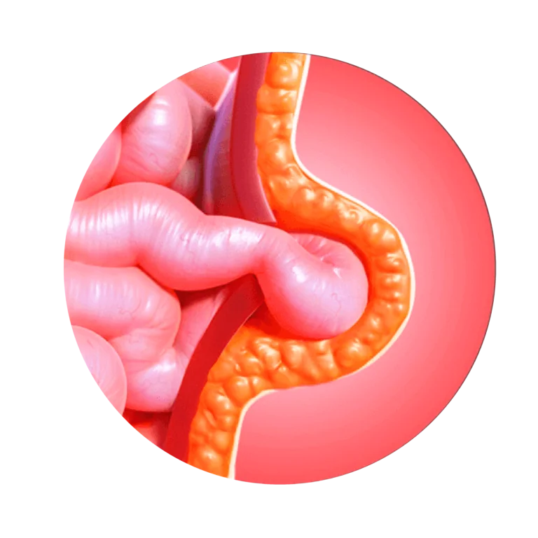 hernias inguinales en niños